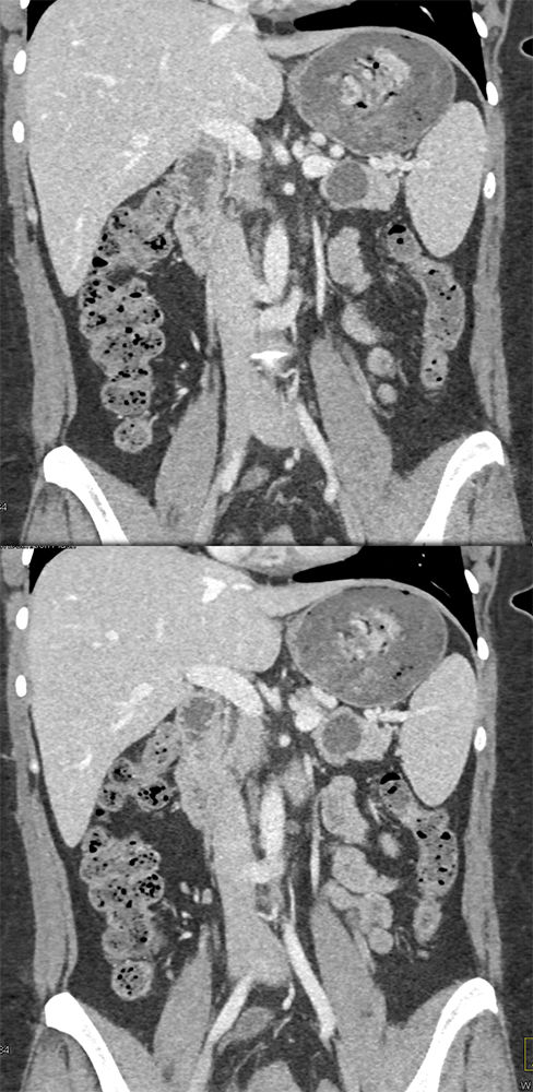 Mucinous Cystic Neoplasm