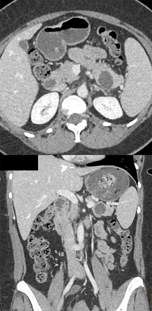 Mucinous Cystic Neoplasm