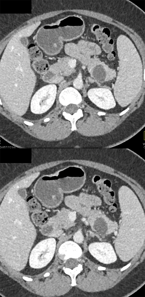 Mucinous Cystic Neoplasm