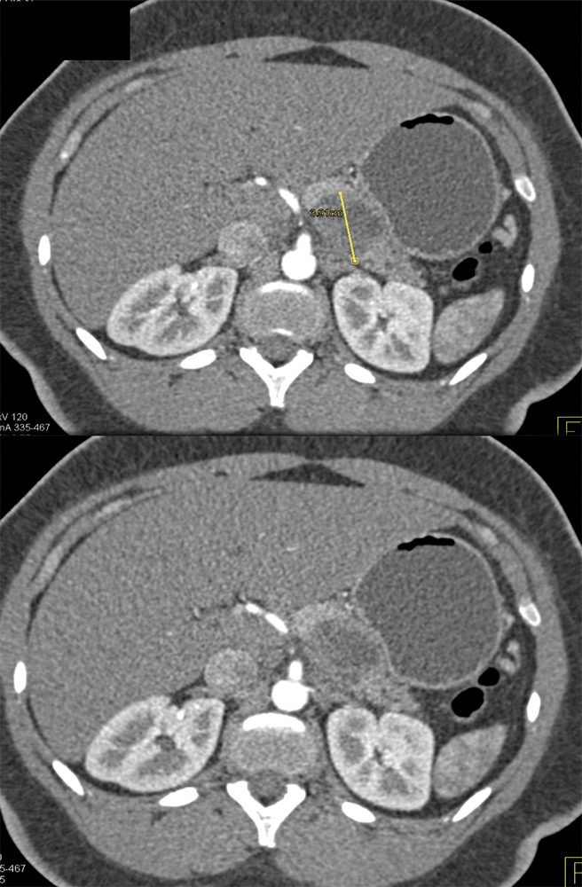 Evaluate Pancreatic Mass