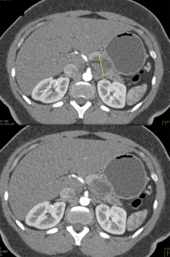 MCN with Intermediate Grade Dysplasia