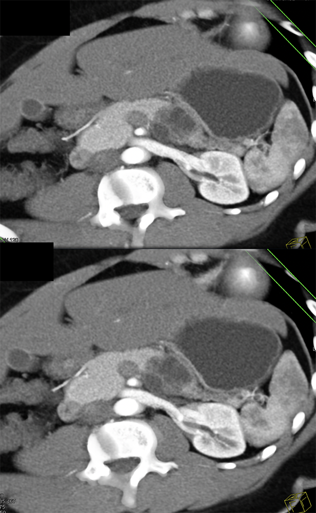 Mucinous Cystic Neoplasm