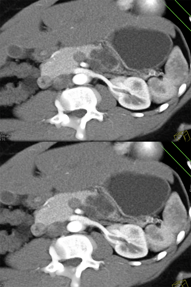 Mucinous Cystic Neoplasm