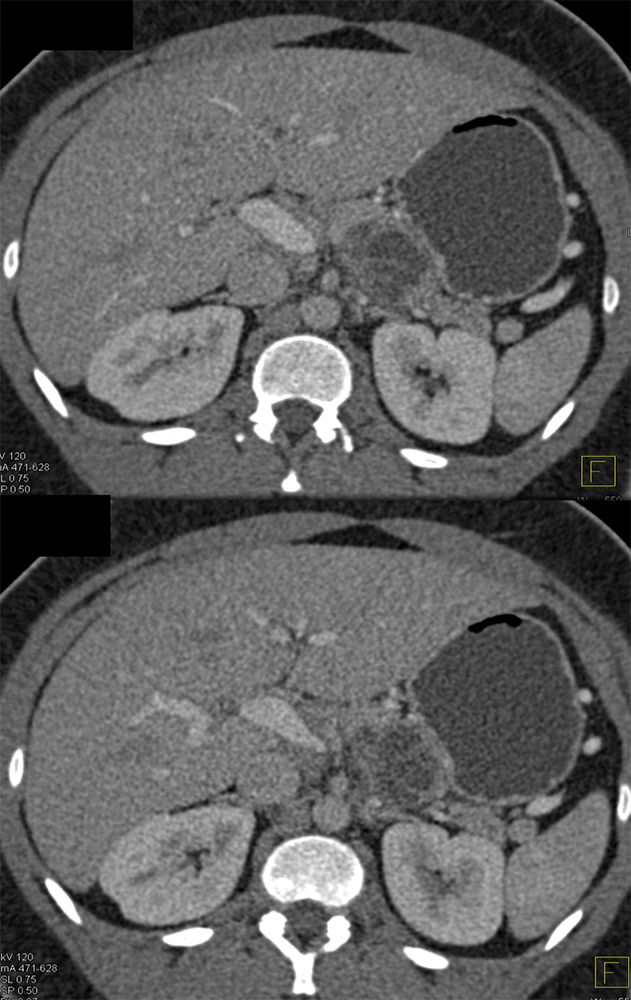 Mucinous Cystic Neoplasm