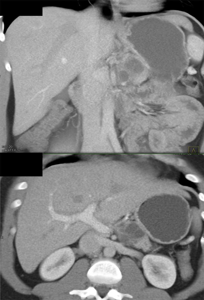 Mucinous Cystic Neoplasm