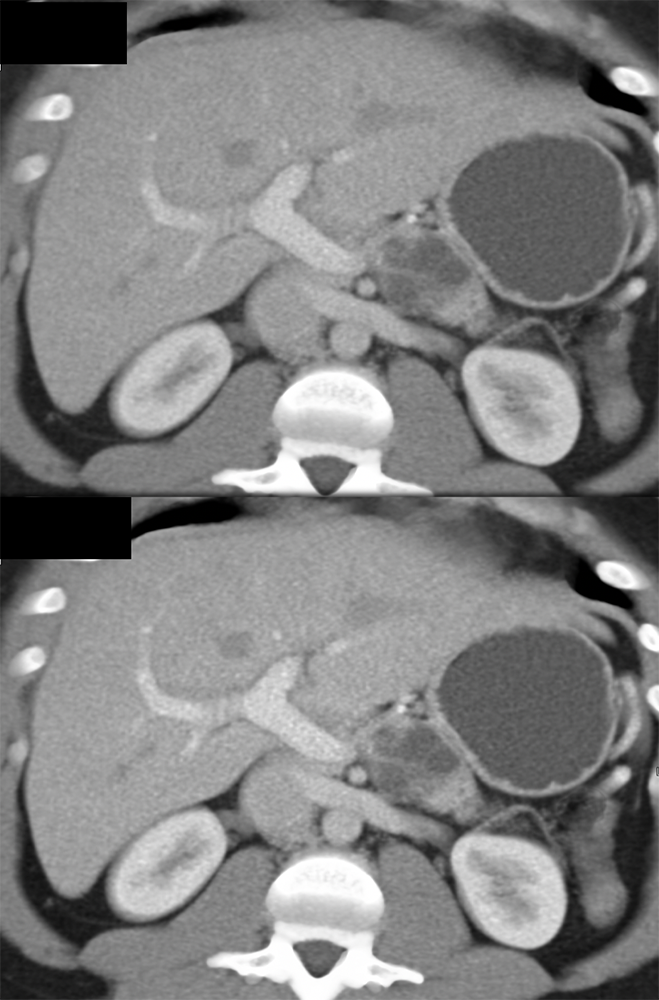 Mucinous Cystic Neoplasm