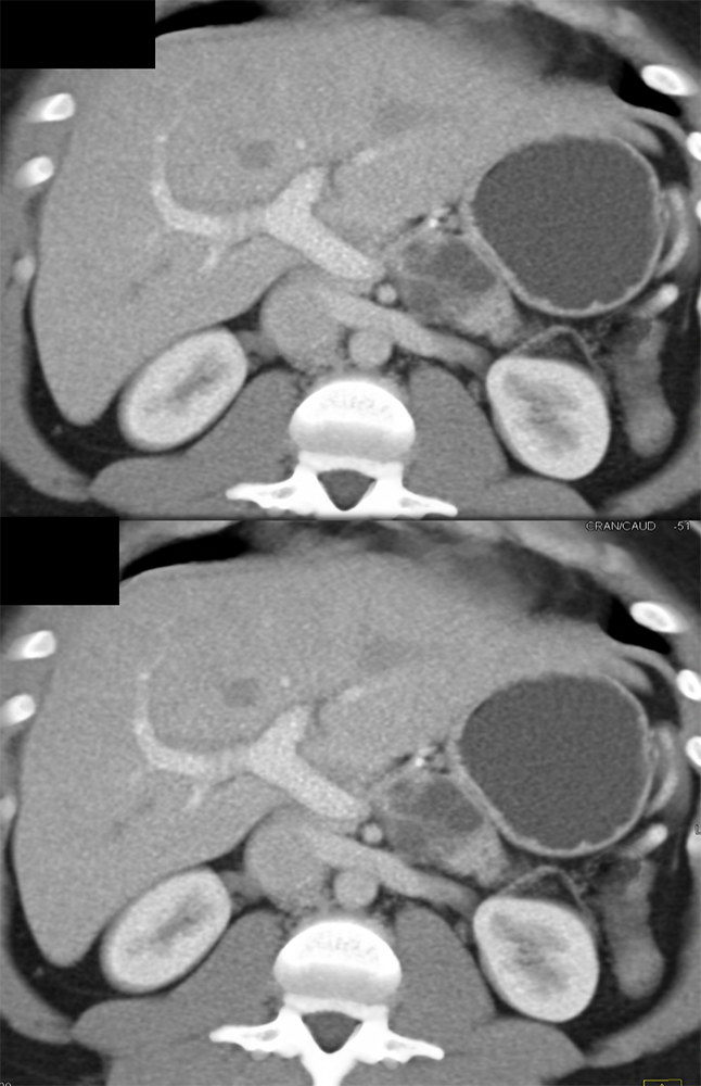 Mucinous Cystic Neoplasm