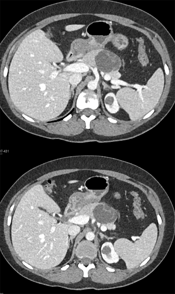 Mucinous Cystic Neoplasm