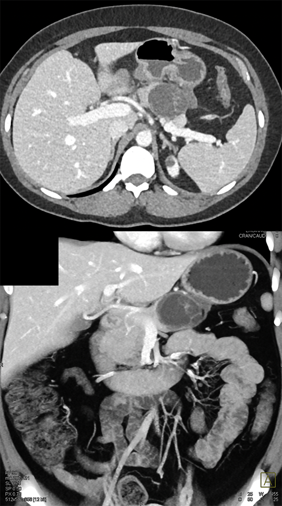 Mucinous Cystic Neoplasm