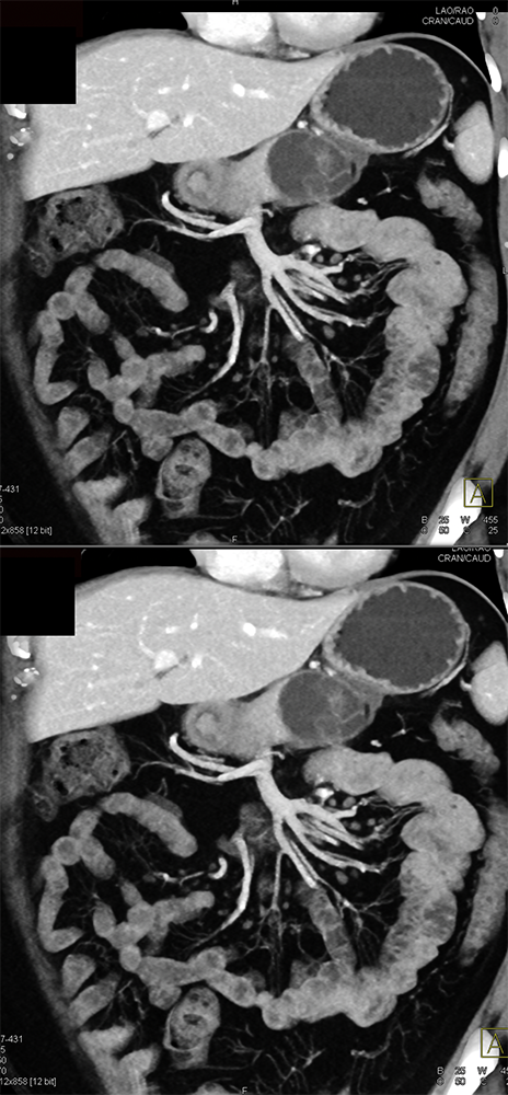 Mucinous Cystic Neoplasm