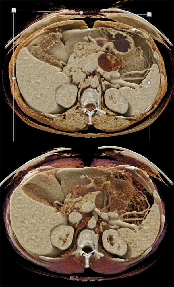 Mucinous Cystic Neoplasm