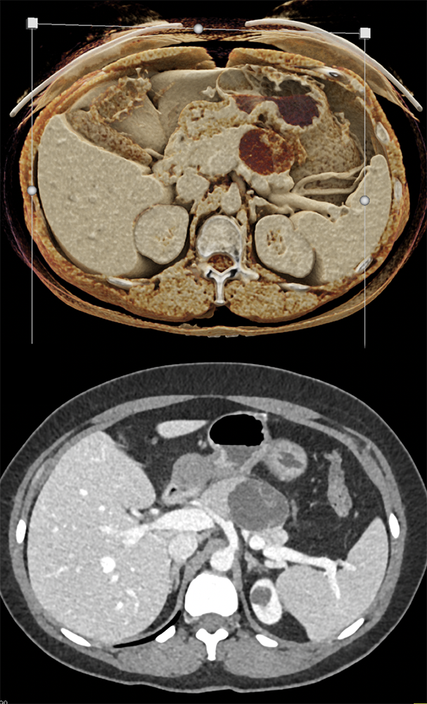 Mucinous Cystic Neoplasm