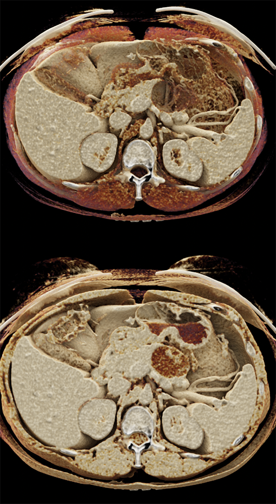 Mucinous Cystic Neoplasm