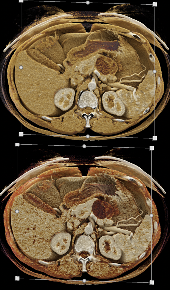 Mucinous Cystic Neoplasm