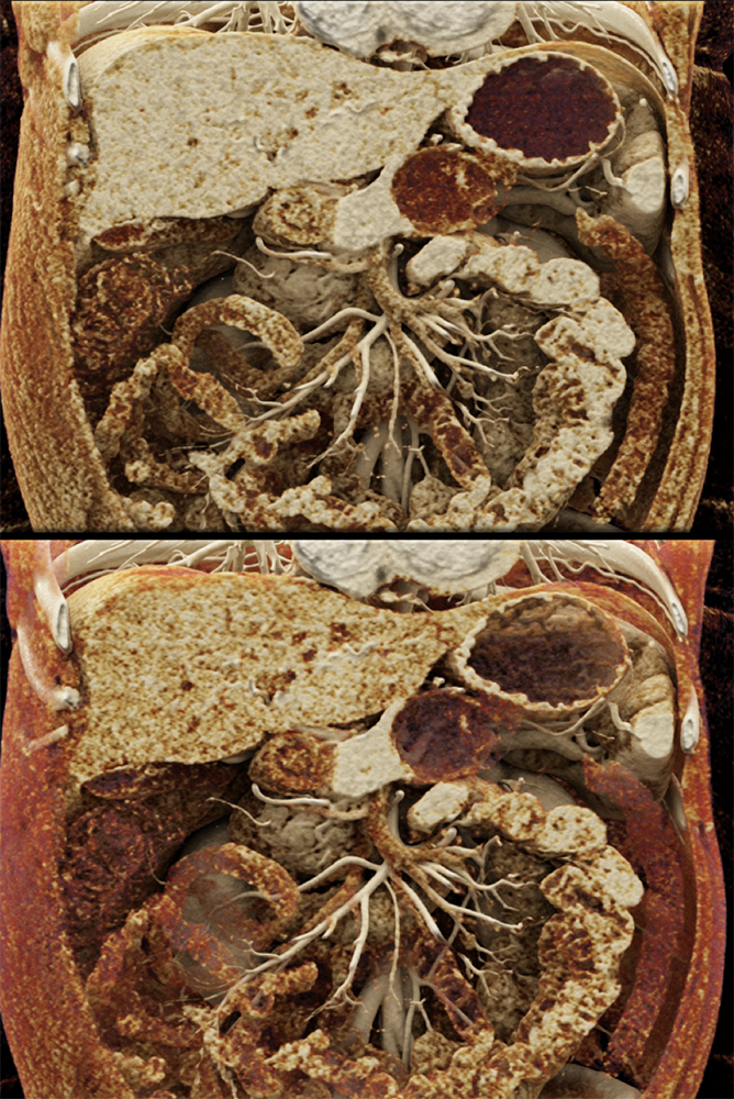 Mucinous Cystic Neoplasm