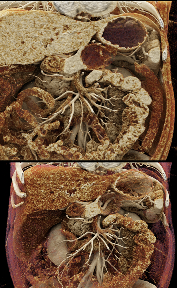 Mucinous Cystic Neoplasm