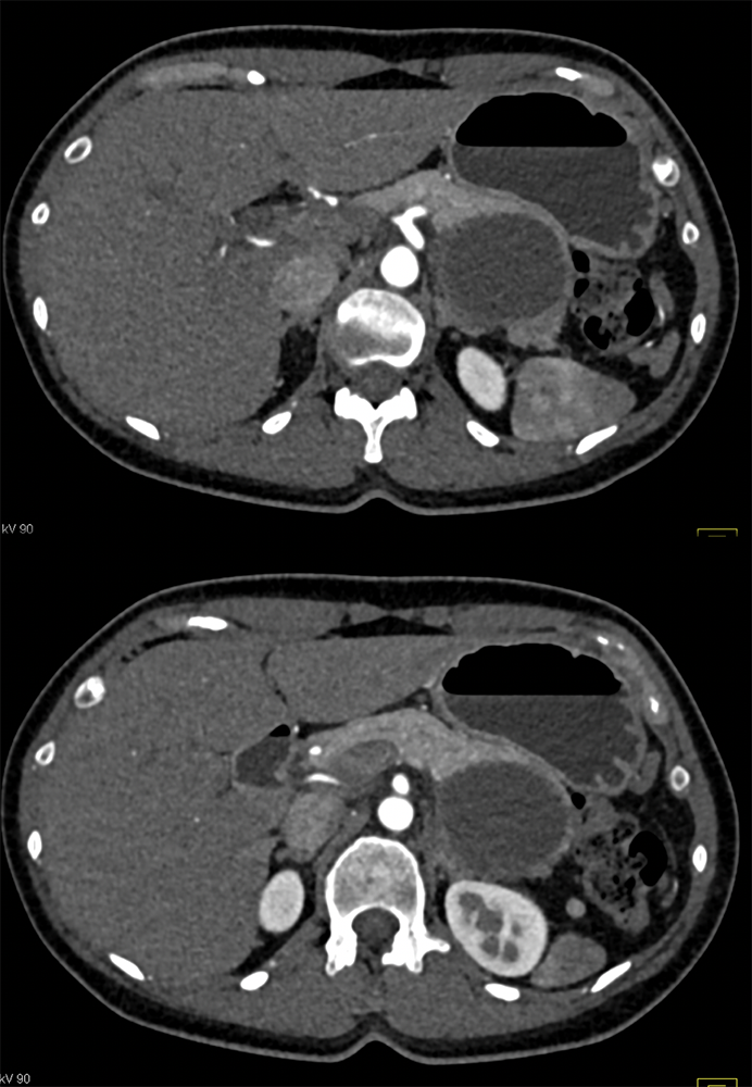 Evaluate Pancreas Mass