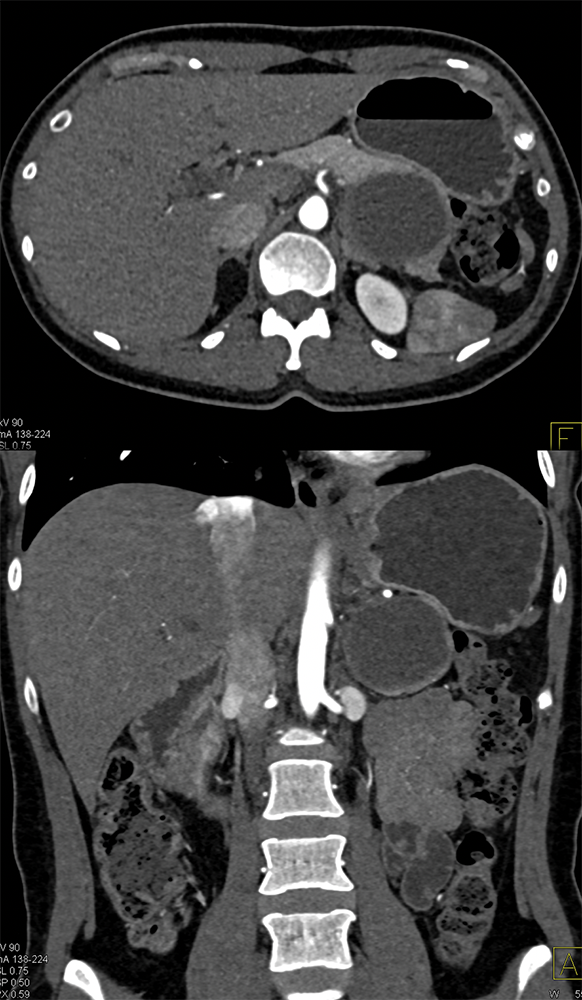 Mucinous Cystic Neoplasm