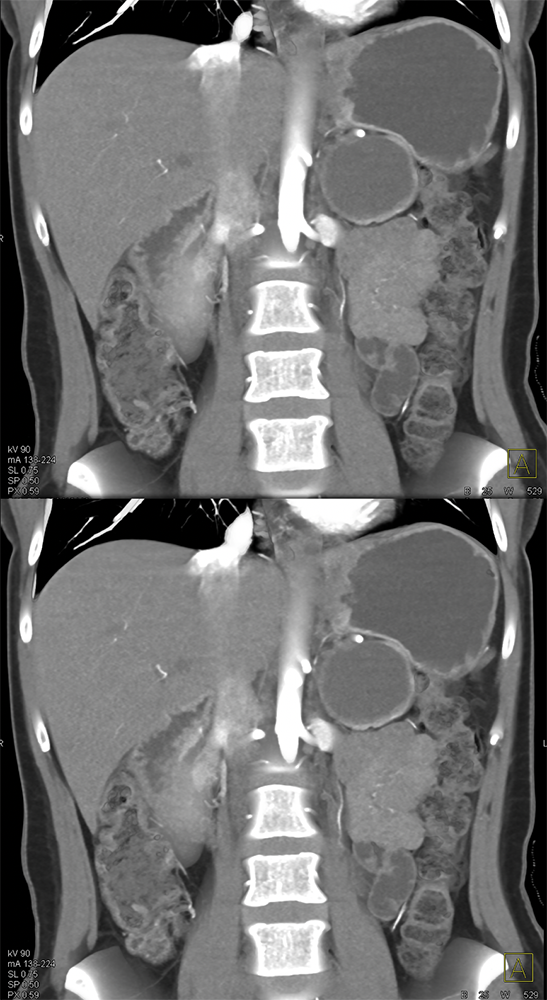 Mucinous Cystic Neoplasm