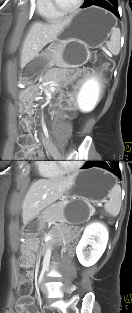 Mucinous Cystic Neoplasm