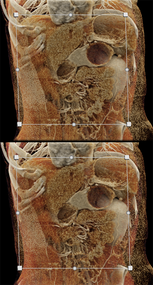 Mucinous Cystic Neoplasm