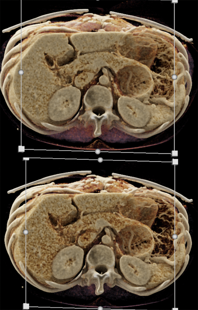 Mucinous Cystic Neoplasm