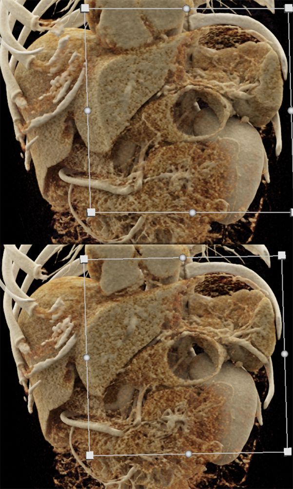 Mucinous Cystic Neoplasm