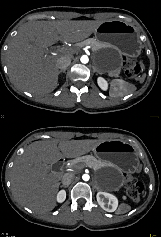 MCN with Low Grade Dysplasia