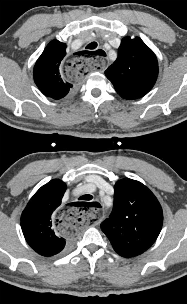 Achalasia