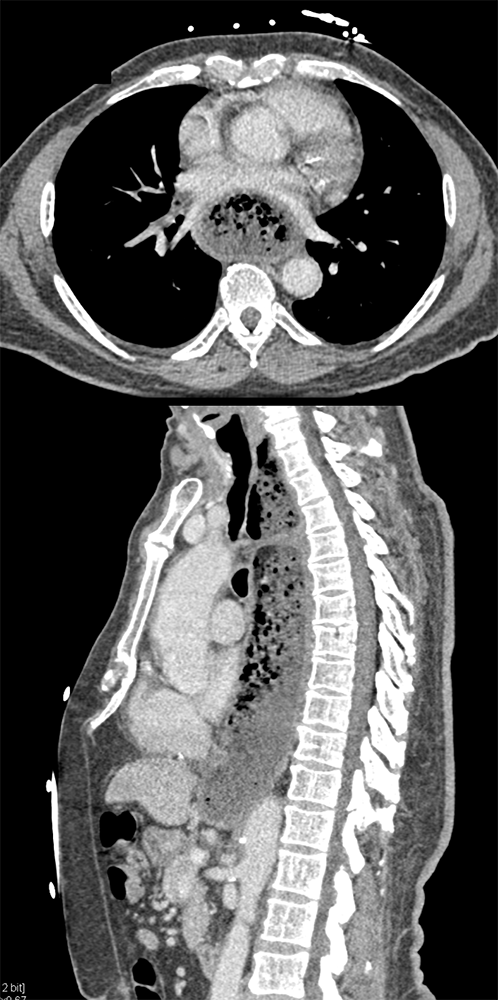 Achalasia