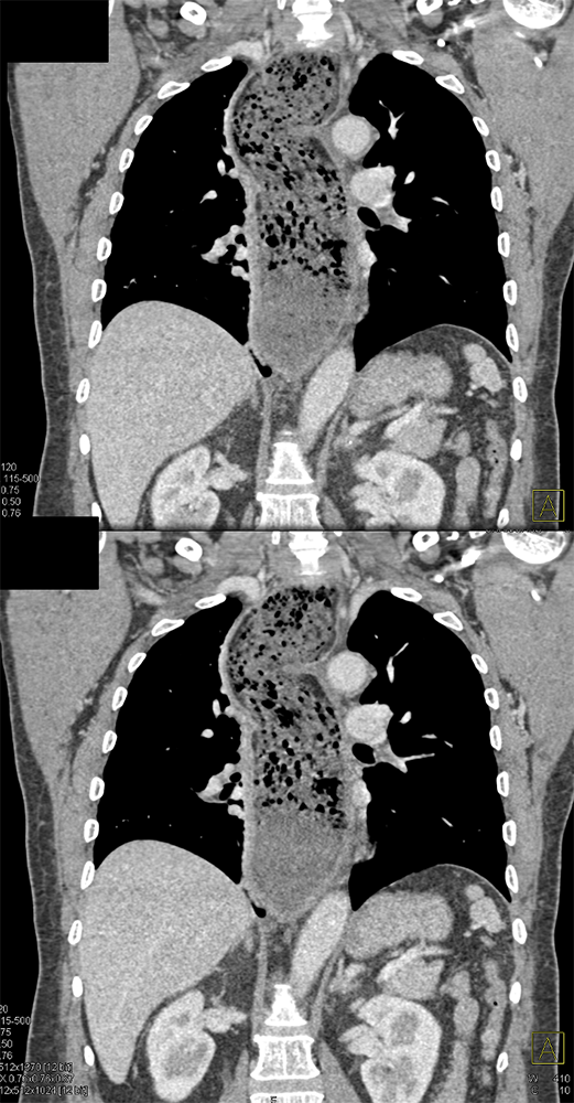 Achalasia