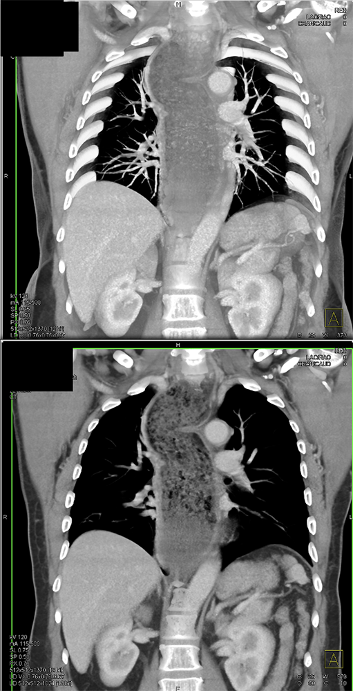 Achalasia