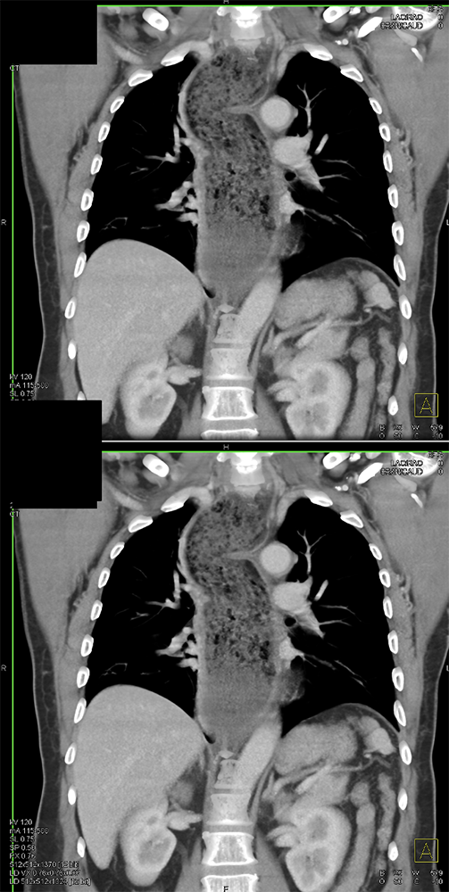 Achalasia