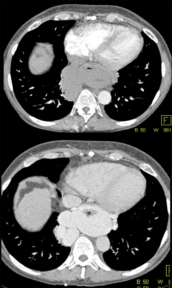 Achalasia