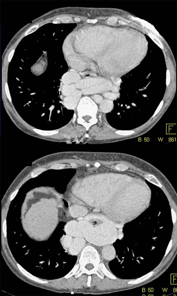 Esophageal Varices