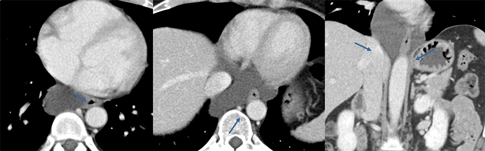 Esophageal Duplication Cyst