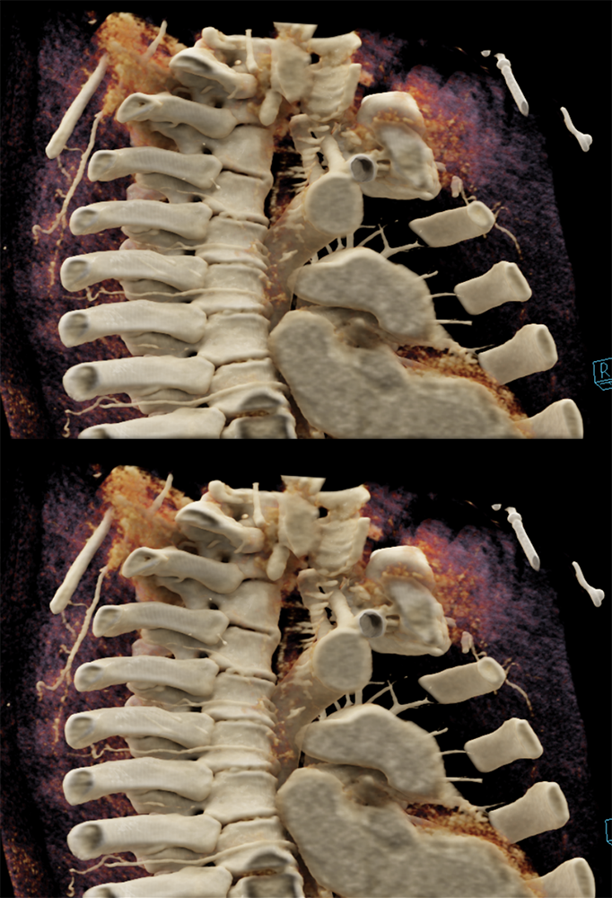 Ectopic Parathyroid Adenoma