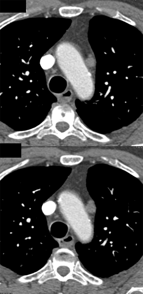 Ectopic Parathyroid Adenoma