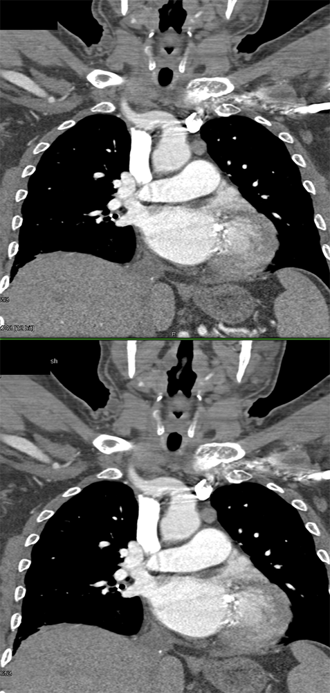 Ectopic Parathyroid Adenoma