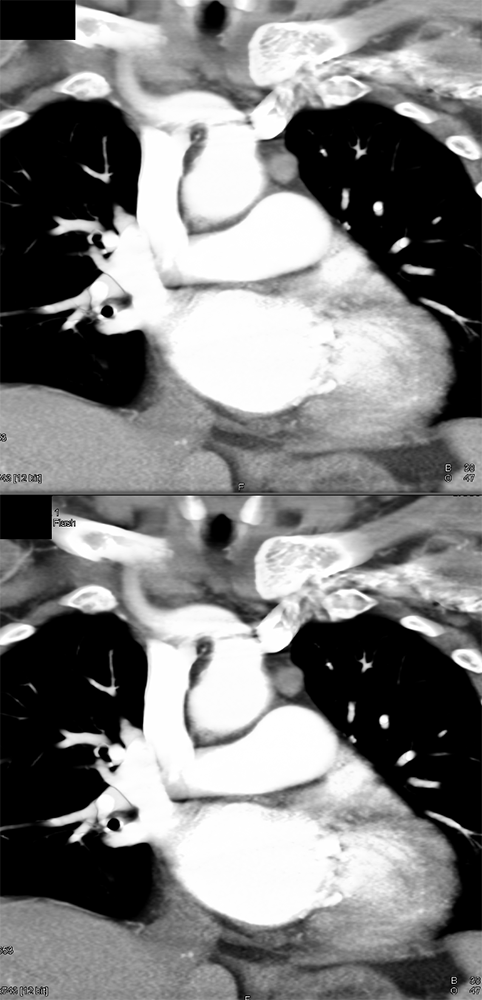 Ectopic Parathyroid Adenoma