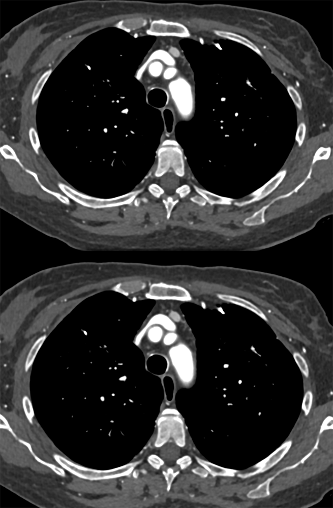 Ectopic Parathyroid Adenoma