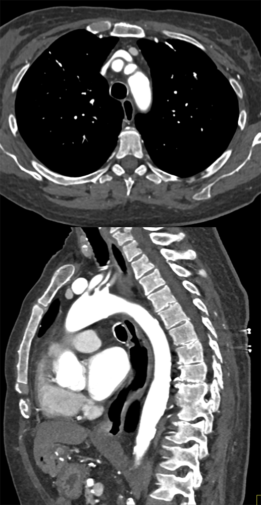 Ectopic Parathyroid Adenoma