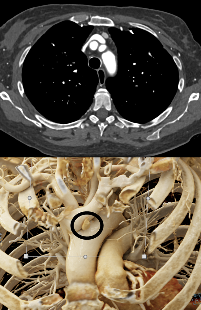 Ectopic Parathyroid Adenoma