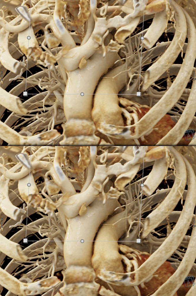 Ectopic Parathyroid Adenoma