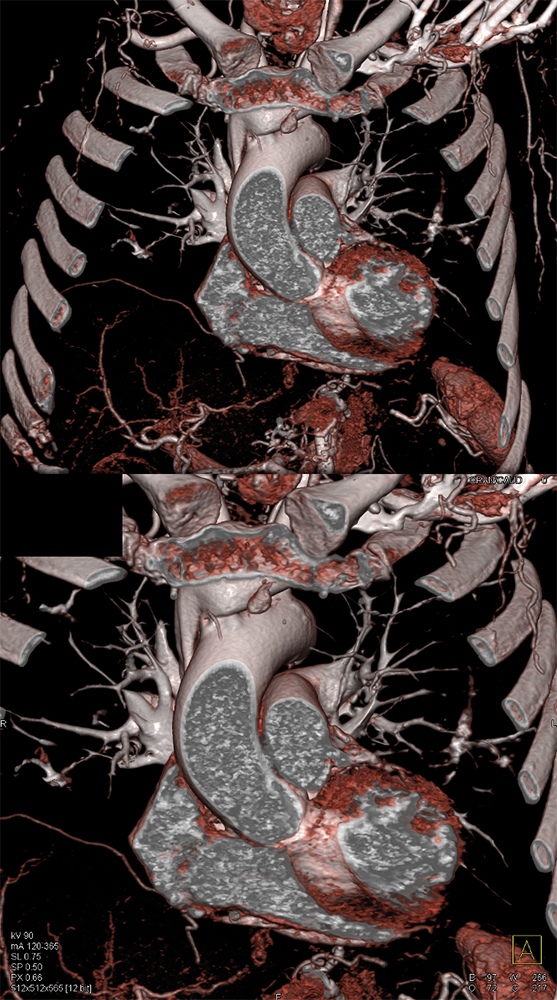 Ectopic Parathyroid Adenoma