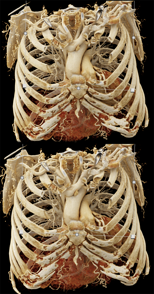 Ectopic Parathyroid Adenoma