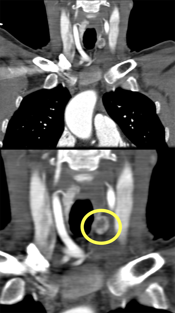 Ectopic Parathyroid Adenoma