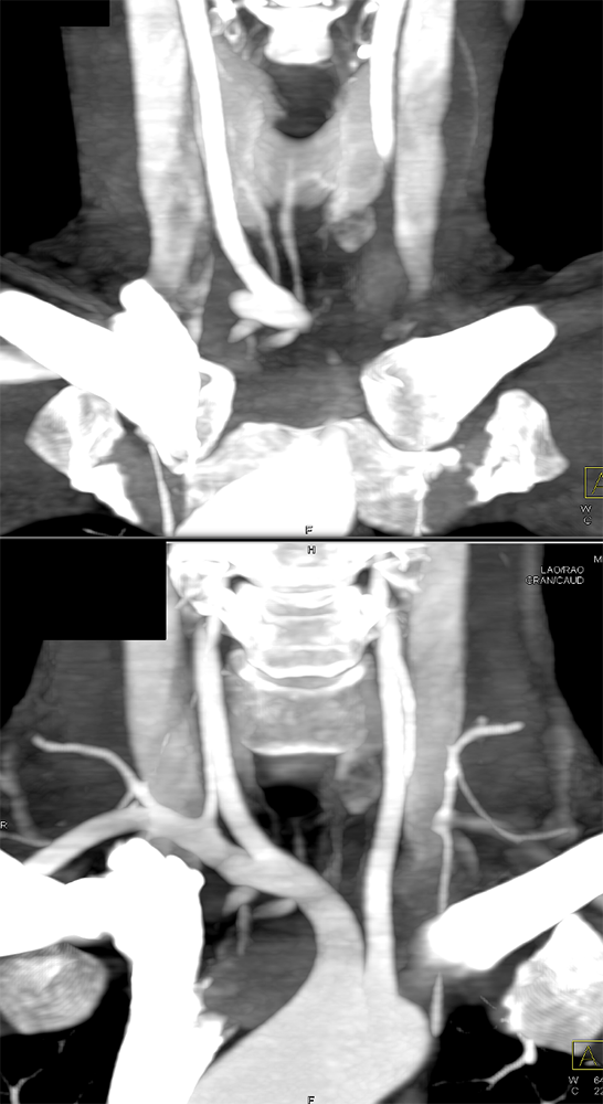 Ectopic Parathyroid Adenoma