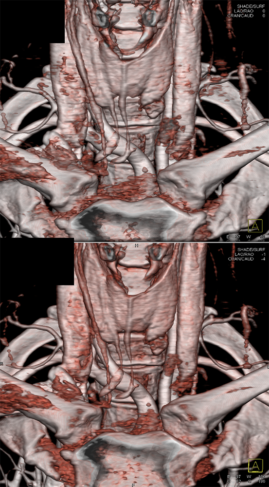 Ectopic Parathyroid Adenoma