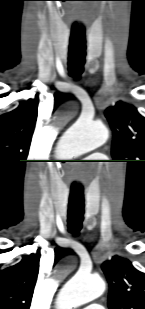 Ectopic Parathyroid Adenoma